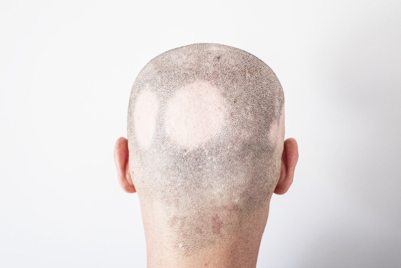 Unveiling hope: understanding alopecia areata and the healing potential of Hairback™